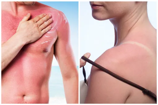 Солнышком стукнуло: народные способы борьбы с солнечными ожогами Солнышком стукнуло: народные способы борьбы с солнечными ожогами