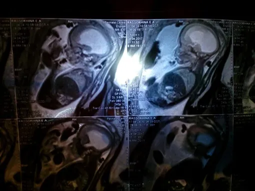 МРТ Лизы МРТ Лизы