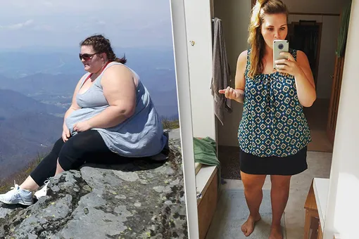 Как худеть после ушивания желудка? Рассказ пациентки