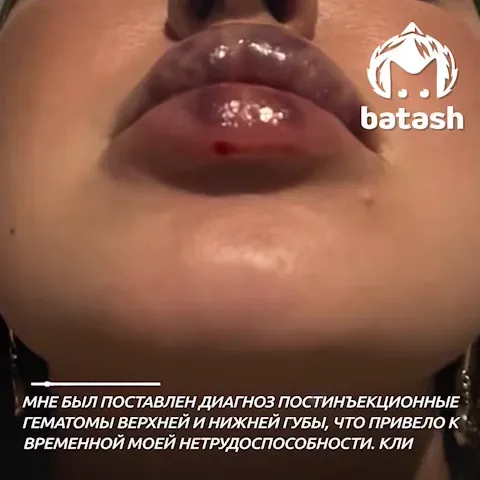 Неудачное увеличение губ Неудачное увеличение губ