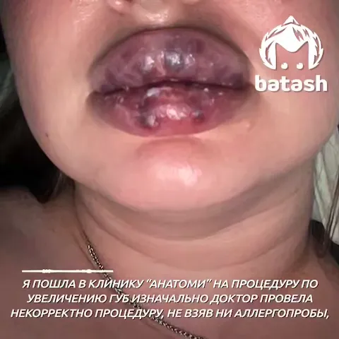 Неудачное увеличение губ Неудачное увеличение губ