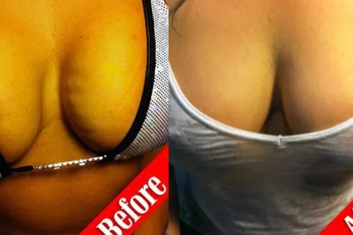 Никакой хирургии: грудь можно увеличить с помощью собственной крови Никакой хирургии: грудь можно увеличить с помощью собственной крови