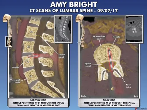 Результаты компьютерной томографии Эми Брайт