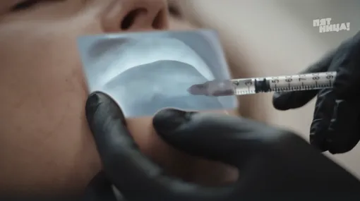 Размягчение фиброза инъекциями Размягчение фиброза инъекциями