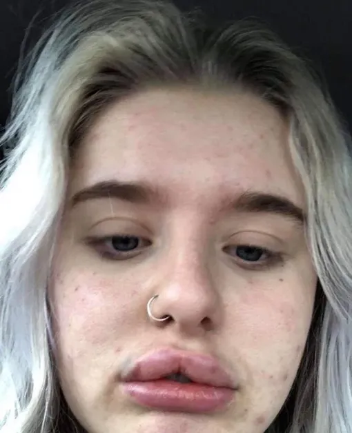 Анна после введения филлеров неудачная пластика губ