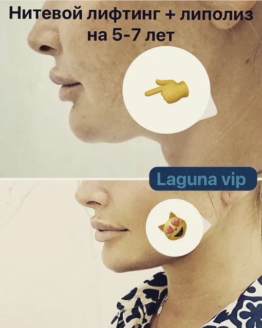 Дана Борисова после пластики