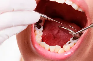 Кариес: найти и обезвредить