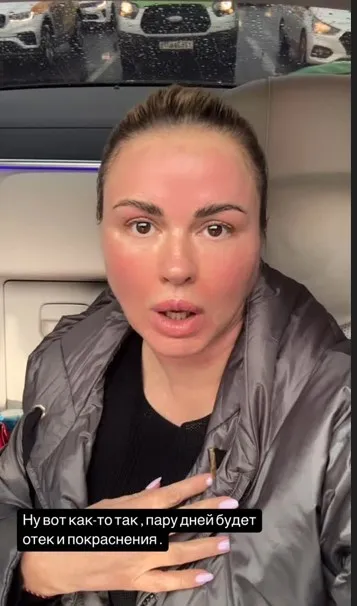 Анна Семенович показала результат игольчатого RF-лифтинга