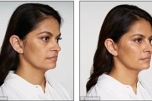 Наполните кожу в 30, и вам не придется делать пластику в 50. Косметологи предлагают новую схему омоложения Наполните кожу в 30, и вам не придется делать пластику в 50. Косметологи предлагают новую схему омоложения