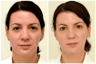 Что происходит с внешностью, если пить по 8 стаканов воды в день