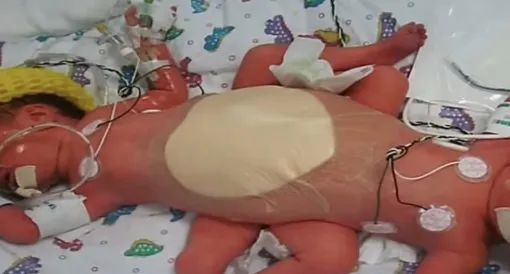 Скарлетт и Химена вскоре после рождения