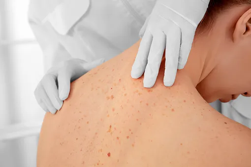 Не только родинки: 5 симптомов рака кожи, которые заметит ваш косметолог Не только родинки: 5 симптомов рака кожи, которые заметит ваш косметолог
