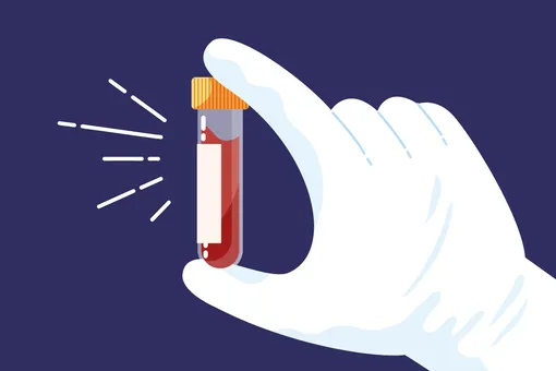 Как по анализу крови определить болезнь Альцгеймера за 10 лет до ее начала? Как по анализу крови определить болезнь Альцгеймера за 10 лет до ее начала?