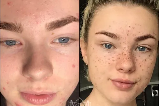 Зачем они это делают? Веснушки-татуировки — странное поветрие Зачем они это делают? Веснушки-татуировки — странное поветрие