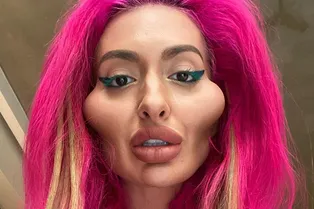 Просто королева. Девушка сделала себе самые большие скулы в мире Просто королева. Девушка сделала себе самые большие скулы в мире