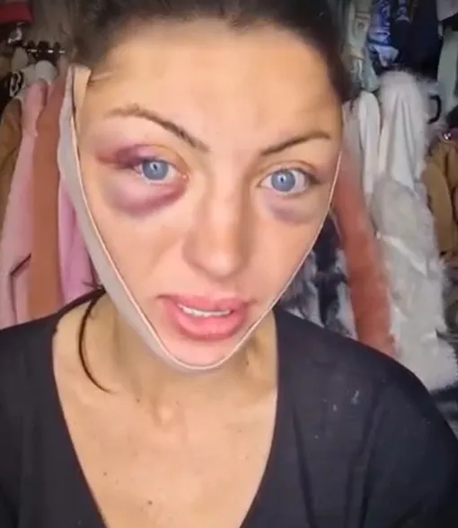 Незадолго до смерти Барбара показала себя почти сразу же после пластики Незадолго до смерти Барбара показала себя почти сразу же после пластики