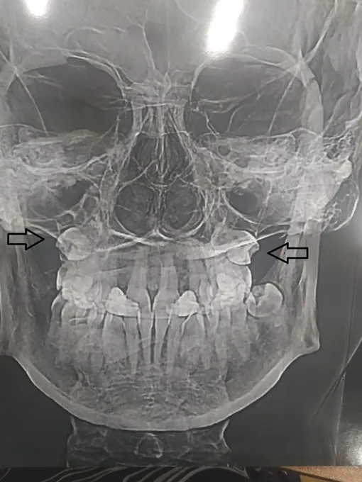 ретенция премоляров ретенция премоляров