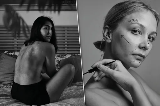 «На спине — карта мира»: фотограф показал снимки девушек с особенностями «На спине — карта мира»: фотограф показал снимки девушек с особенностями