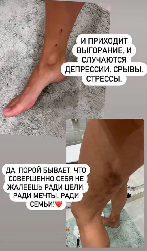 Тодоренко показала фото травм Тодоренко показала фото травм